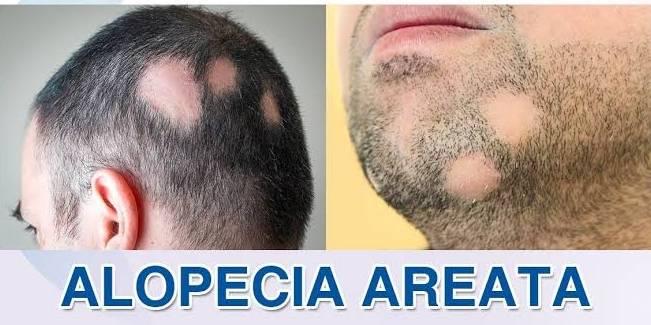 एलोपेसिया अरीटा (Alopecia Areata Treatment) एवं टूटते झड़ते बालों का 100% प्राचीन आयुर्वेदिक इलाज